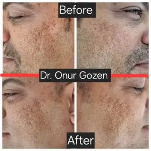 Morpheus8 before and after