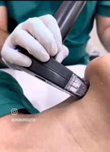 Morpheus 8 non-surgical skin rejuvenation